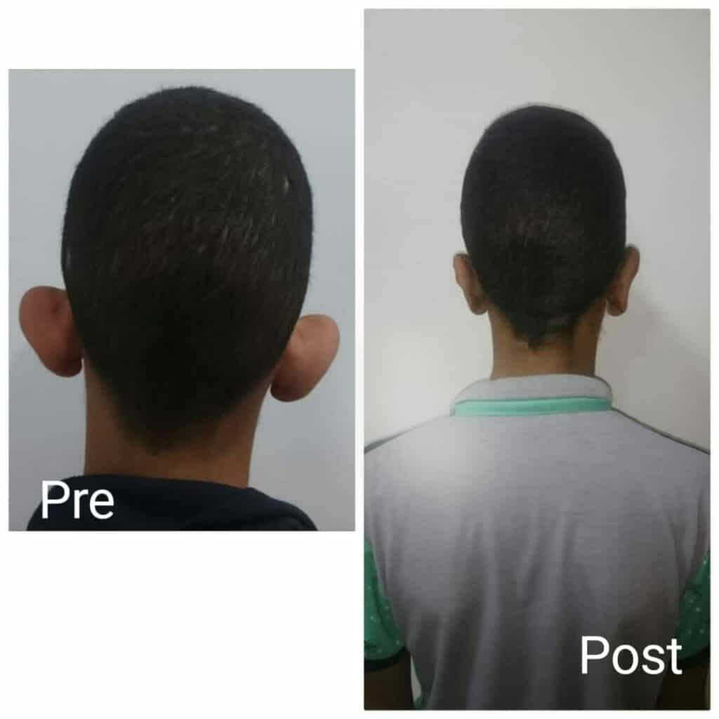 Ear plastic surgery in Hurghada